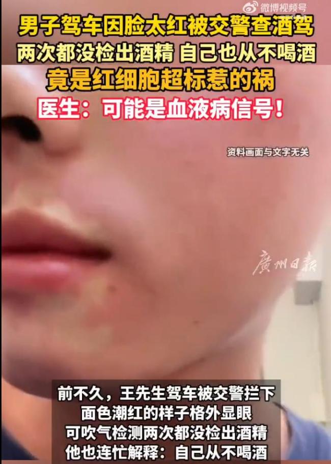 男子脸红被查酒驾查出血液病